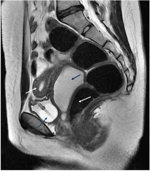 RMN abdominal que evidencia hematometrocolpos secundario a atresia vaginal distal. Flechas azules: vejiga (anterior) con sonda vesical en su interior y vagina con abundante contenido hemorrágico en su interior (hematocolpos). Flechas blancas: útero (superior) y recto (inferior).