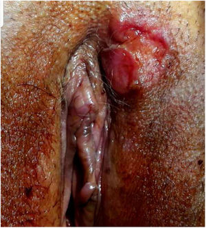 Aspecto clínico. Se observa una placa tumoral ulcerada en labio mayor izquierdo con bordes carnosos y centro ulcerado.