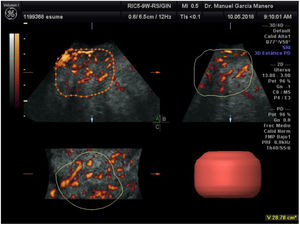 Valoración del volumen del mioma y su vascularización mediante ecografía 3D multiplanar.