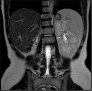 Secuencia coronal de la RM de abdomen sin contraste potenciada en T2 en la que se aprecia agenesia renal derecha y riñón izquierdo único compensador.