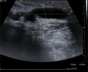 Lesión quística bien delimitada, localizada en el interior del canal inguinal, en forma de coma y con la cola dirigida cranealmente hacia la cavidad peritoneal.