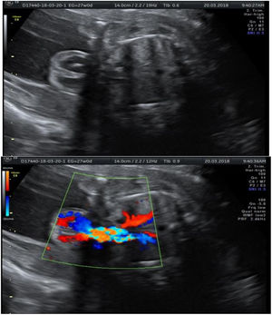 Corte axial de caja torácica fetal con ausencia de esternón (defecto torácico) y presencia de ectopia cordis. Tomado de estudio ecográfico de paciente.