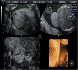 Defecto de pared abdominal superior provocando protrusión de parénquima hepático. Tomado de estudio ecográfico de paciente.
