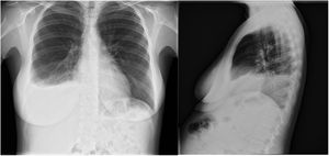 Radiografía de tórax en la que se aprecia derrame pleural derecho con índice cardiopulmonar conservado.
