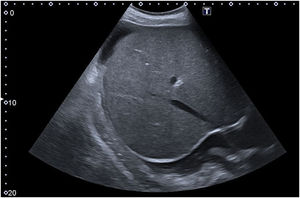 Ecografía abdominal donde se objetiva hígado de bordes lisos con tamaño y ecogenicidad conservada y ascitis en moderada cuantía.
