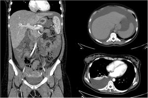 TAC toracoabdominal: índice cardiotorácico dentro de la normalidad. No se identifican infiltrados ni nódulos en el parénquima pulmonar. Derrame pleural derecho con atelectasia pasiva asociada. Líquido libre intraabdominal en cuantía significativa. Útero aumentado de tamaño, probablemente demasiado para lo esperado en una puérpera de 3 meses.