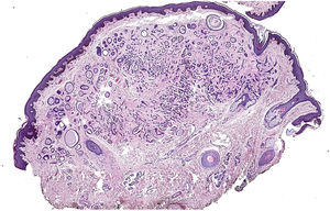 Punch cutáneo tras tinción con hematoxilina-eosina, con óptica ×2. Obsérvese la ocupación tumoral de la dermis superficial y media, con respeto de la epidermis y de la dermis profunda.
