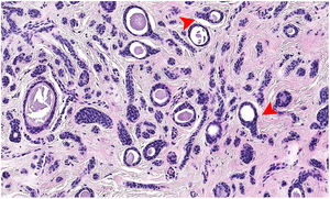 Detalle con microscopio óptico a ×20 aumentos. Son particularmente evidentes a este nivel las estructuras glandulares con forma de «renacuajo» (flechas), características de este tumor.