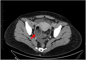 Lesión sólida quística sugestiva de teratoma adyacente a útero y ovario derecho (flecha).