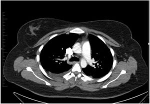 Derrame pleural bilateral. No se observaron masas, adenopatías ni imágenes sugestivas de tromboembolia pulmonar.