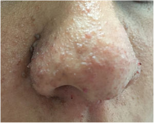 Lesiones en piel en región facial tipo «confetti».