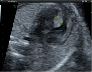 Masa homogénea hiperecoica en septo interventricular en gemela B. Fuente: Clínica Universitaria Colombia.