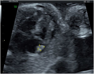 Rabdomioma en aurícula derecha en gemela B. Fuente: Clínica Universitaria Colombia.
