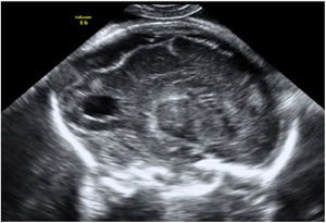 Lesiones cerebrales a nivel prefrontal en un feto de 23 semanas de gestación. Fuente: Mauricio Herrera.
