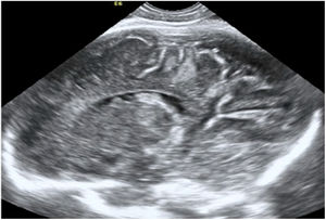 Lesiones cerebrales a nivel parietal en un feto de 33 semanas de gestación. Fuente: Mauricio Herrera.