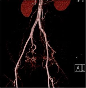 Angiotomografía con reconstrucción 3D, donde se observan las arterias iliacas internas (hipogástricas), con un aproximado de 3 a 4 cm de largo, con dos ramas: un tronco anterior y un tronco posterior.