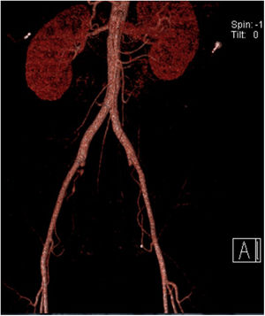 Angiotomografia con reconstrucción en 3D, posterior a ligadura de las arterias hipogástricas (ligadura proximal y tronco posterior bilaterales).