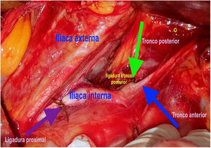 Sitios de ligadura de la arteria iliaca interna izquierda, proximal (flecha morada); y distal (flecha verde) del tronco posterior.