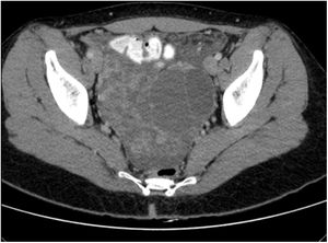 TAC toracoabdominal con masa ovárica compatible con neoplasia con ascitis e implantes pélvicos.