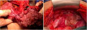 Cirugía radical vía laparotomía: se observa una importante afectación tumoral de ambos anejos, pelvis y peritoneo.