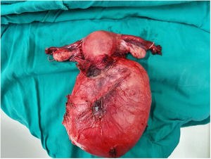 Macroscopia: se observa la lesión extensa dependiente del cuello uterino.