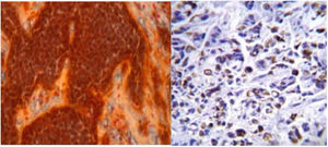 Microscopia: se observa el patrón sólido, mediante la coloración tricrómica de Dane. Inmunorreacción positiva a queratina 7 en el citoplasma de las células tumorales.