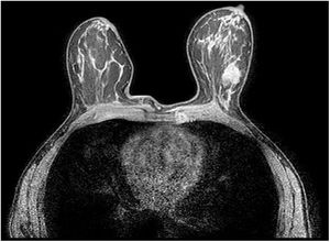 RM: área mal definida en la región retroareolar de la mama derecha, hipercaptante, que requirió seguir ampliando estudio.