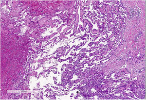Hematoxilina-eosina: se aprecia aumento de los espacios vasculares, anastomosis entre sí e hipercromasia, indicativos de angiosarcoma.