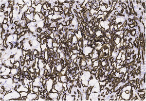 Inmunohistoquímica: CD34+, muestra de pieza quirúrgica del caso. Marcador vascular específico para tumores de esta estirpe.
