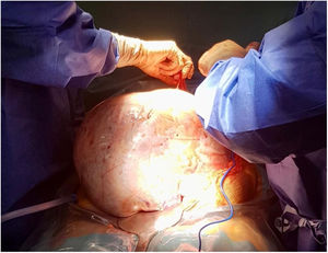 Tumor ovárico gigante. Laparotomía exploradora.