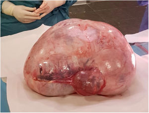 Cistoadenoma mucinoso ovárico y cistoadenofibroma tubárico.