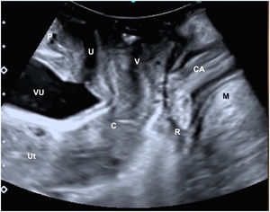 Plano medio-sagital. CA: canal anal; C: cérvix; M: músculo elevador del ano; P: pubis; R: recto; U: uretra; Ut: útero; V: vagina; VU: vejiga urinaria.