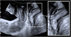 Se observa la ampliación del canal anal donde se visualiza el esfínter anal interno hipoecoico (*) y el esfínter anal externo hiperecoico (o).