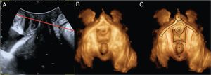 A) Muestra el plano medio-sagital del suelo pélvico. B y C) La línea roja referencia el PMD en el plano medio-sagital y su correspondencia en el plano axial.A: canal anal; M: músculo elevador del ano; P: pubis; U: uretra; V: vagina.