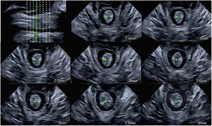 Valoración axial multicortes del esfínter anal.