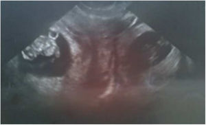 Ecografía transvaginal 2D; se observan una gestación intrauterina con embrión vivo y otra gestación anexa al útero y fuera de este, con embrión vivo.