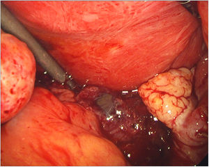 Intervención quirúrgica; gestación extrauterina en hoja posterior del ligamento ancho derecho.