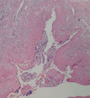 Examen microscópico, corte transversal de vellosidades coriales, teñido con hematoxilina y eosina. Se observa trofoblasto invadiendo células musculares.