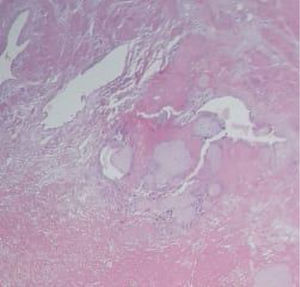 Microscopía, corte transversal de vellosidades coriales, teñido con hematoxilina y eosina. Se observa trofoblasto inmaduro invadiendo capa de miometrio.