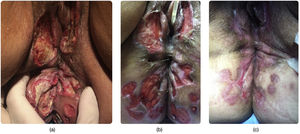 Primer ingreso. A) Aspecto de las lesiones ulceradas extensas en el primer ingreso hospitalario. B) Lesiones tras el desbridamiento inicial y una semana de curas locales bajo cobertura antibiótica empírica. C) Aspecto de las lesiones ulceradas tras un mes.