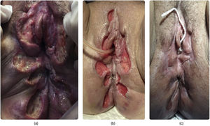 Segundo ingreso. A) Aspecto de las lesiones ulceradas extensas en el segundo ingreso hospitalario. B) Lesiones tras el desbridamiento inicial y una semana de curas locales bajo cobertura antibiótica empírica. C) Aspecto de las lesiones ulceradas tras un mes.