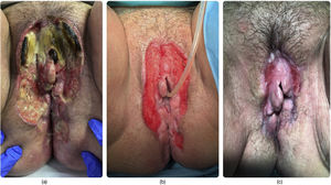 Tercer ingreso. A) Aspecto de las lesiones ulceradas extensas en el tercer ingreso hospitalario. Destaca las zonas necróticas en el tercio superior. B) Lesiones cubiertas por apósito hidrocoloide, tras el desbridamiento inicial y una semana de curas locales sin cobertura antibiótica. C) Aspecto de las lesiones ulceradas tras un mes.