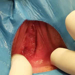 Exploración del tabique vaginal.