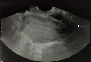 Ecografía transvaginal intraoperatoria. Se observa útero de morfología normal con artefacto de sombra sónica correspondiente a tabique vaginal transverso (flecha).