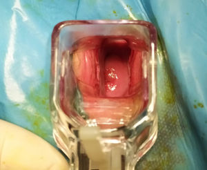 Exploración genital al final de la intervención.