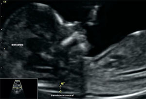 Translucencia nucal: espacio lleno de líquido entre la parte posterior del cuello fetal y la piel suprayacente.