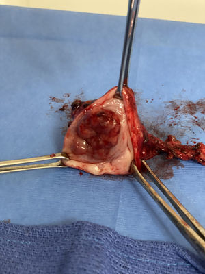 Traquelectomía radical.