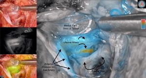 Angiografía intra-operatoria con fluorescencia.