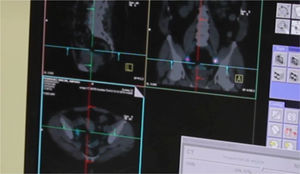 Tomografía computarizada de emisión de positrones (SPECT-TC) para identificar las regiones que reciben drenaje linfático directo del tumor primario y localizar los GC en cavidad abdominal tras inyección de radiofármaco.