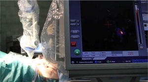 Gammacámara portátil Sentinella 102 (Oncovision). Imagen realizada en el Hospital Virgen Macarena por el servicio de Medicina Nuclear durante la cirugía de detección de ganglio centinela en una paciente diagnosticada de cáncer de endometrio estadio inicialIA.